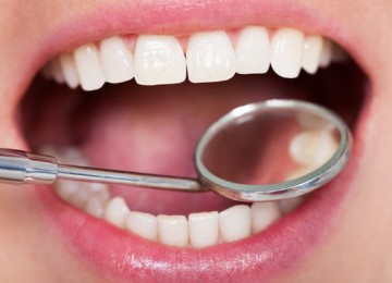 Graphene dental fillings make it more strength and can stay forever