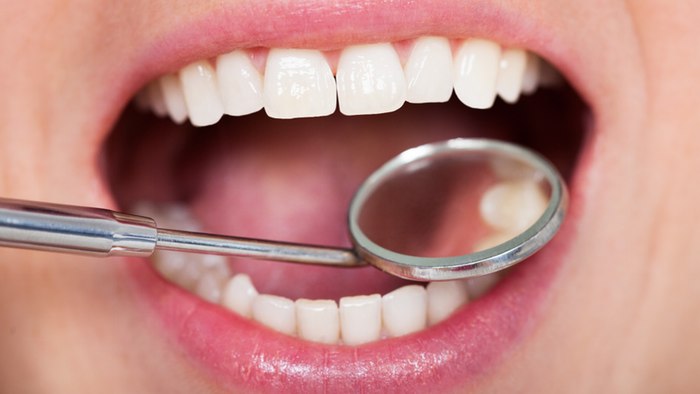 Graphene dental fillings make it more strength and can stay forever